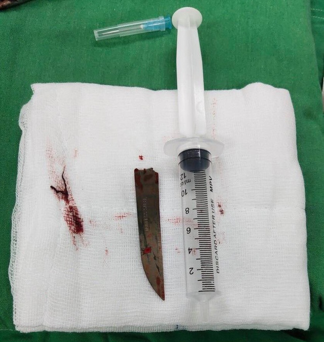 Mang cả mũi dao xuyên cột sống vào phòng phẫu thuật - Ảnh 1.