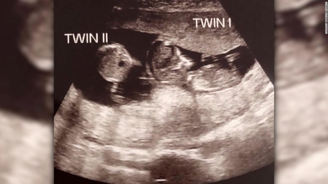 Hiếm gặp: Có bầu khi đang mang thai 3 tháng - Ảnh 1.
