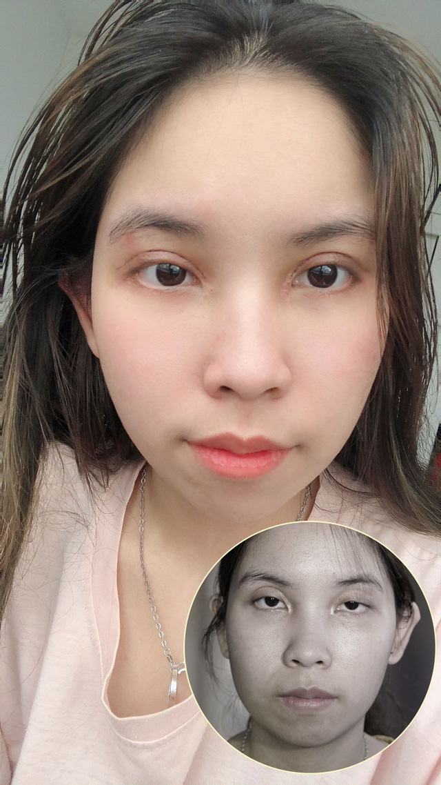 Cắt mí ở spa, nữ sinh viên 18 tuổi tại Hà Nội mất thị lực - Ảnh 1.