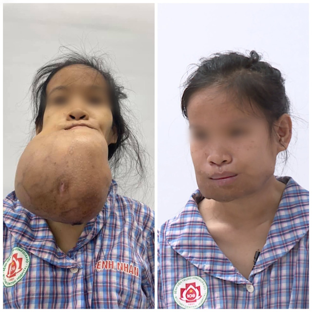 Cô gái trẻ bị biến dạng khuôn mặt vì khối u khổng lồ - Ảnh 1.