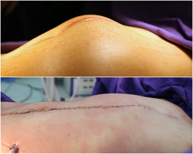Phẫu thuật khối u di căn ổ bụng cho bệnh nhân ung thư tinh hoàn - Ảnh 1.