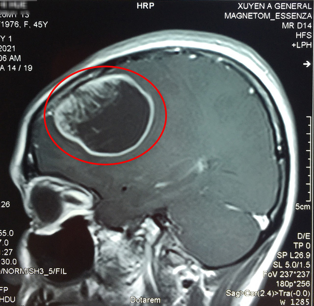 Trí nhớ lẫn lộn, đau đầu, đi khám phát hiện não có khối u to như quả cam - Ảnh 1.