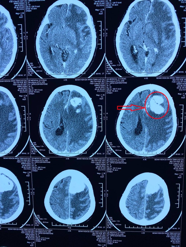 Phẫu thuật khối u não kích thước lớn cho bệnh nhân cao tuổi - Ảnh 1.