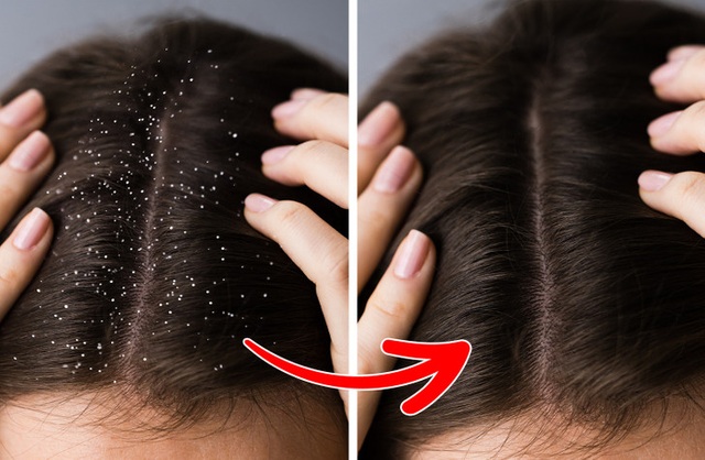 7 bí kíp điều trị hiệu quả tóc gãy rụng, gàu, xơ rối,... - Ảnh 2.