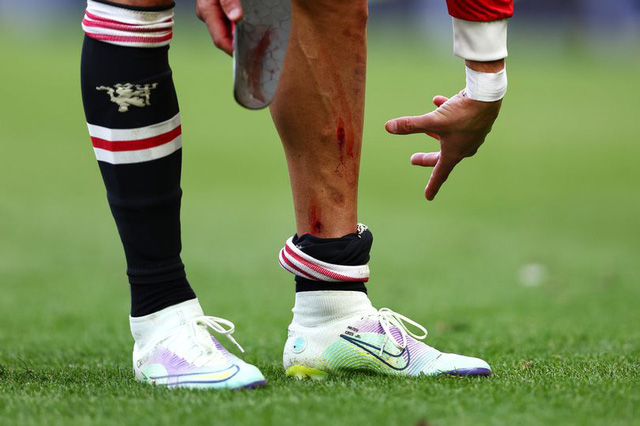 Xem hình ảnh về chấn thương chân để cảm nhận sự kiên cường, bền bỉ của các VĐV vượt qua những thử thách khó khăn trong thể thao.