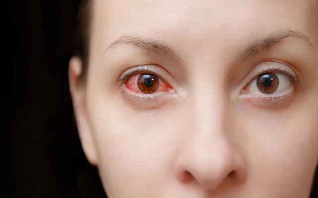 Những bệnh nhiễm trùng mắt liên quan đến COVID- 19 - Ảnh 1.