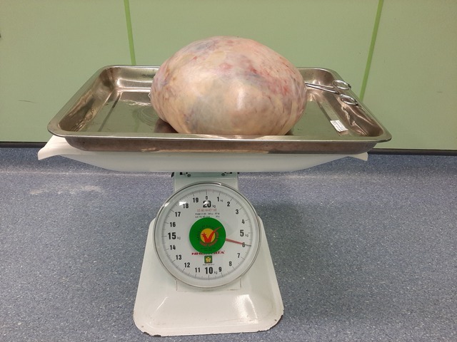 Cắt bỏ khối u nang buồng trứng nặng gần 6kg cho nữ bệnh nhân - Ảnh 1.