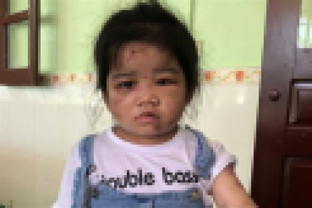 Vụ bé gái 4 tuổi ở Hà Tĩnh nghi bị bạo hành: Dì ruột khai do bé lười ăn nên dùng chổi sắt đánh - Ảnh 1.