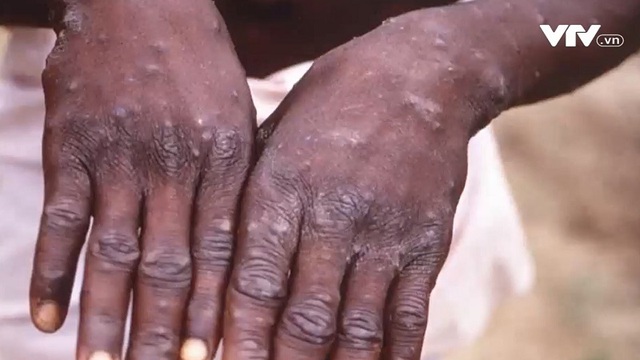 Monkeypox is not contagious like COVID-19 - Photo 1.