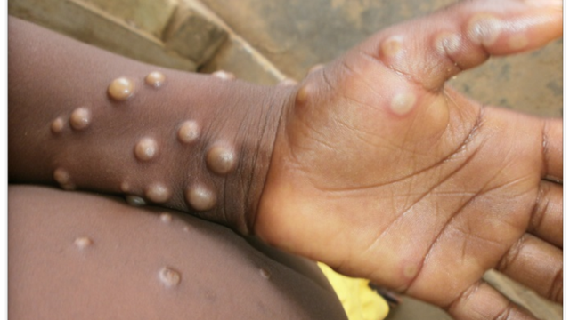 The number of monkeypox infections in Germany increased to 3, the UK confirmed more than 20 cases - Photo 1.