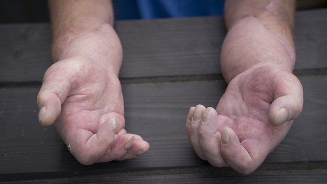 A person with scleroderma received the world's first double hand transplant in the UK - Photo 2.