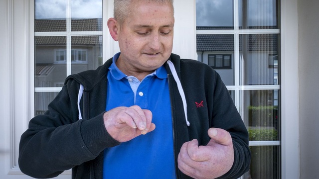 A person with scleroderma received the world's first double hand transplant in the UK - Photo 1.