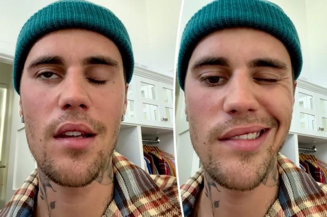 Justin Bieber gặp khó khăn trong ăn uống sau khi liệt nửa mặt - Ảnh 1.