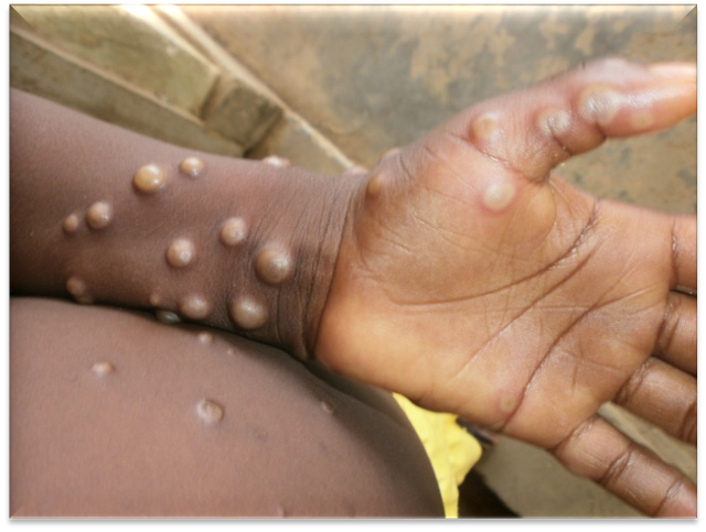 Warning monkey smallpox virus may have spread silently - Photo 3.
