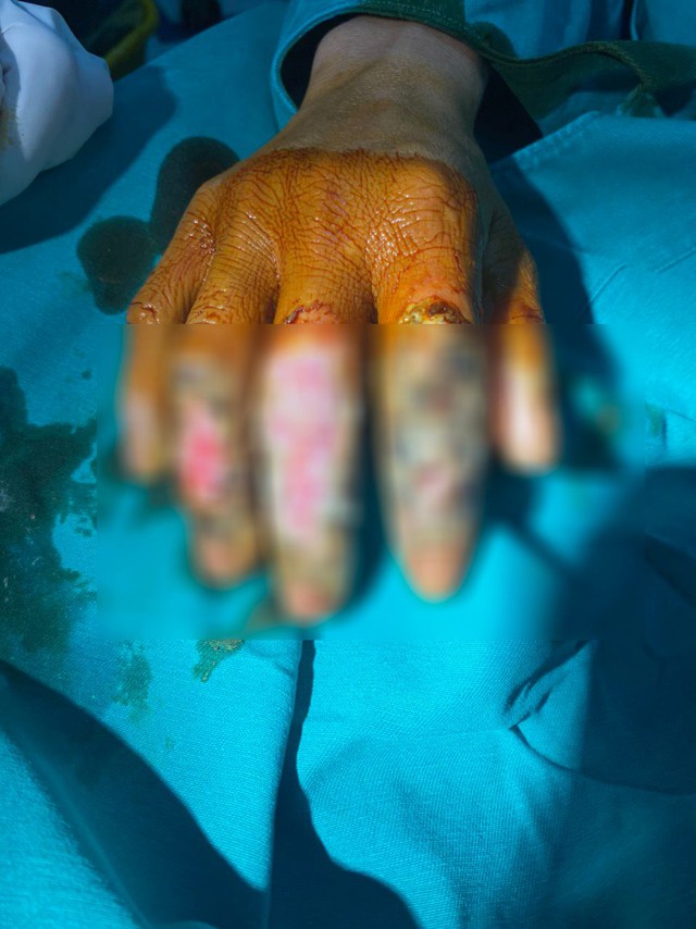 Bàn tay nhiễm trùng nặng do đắp thuốc nam chữa bỏng - Ảnh 1.