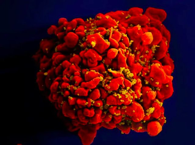 Bệnh nhân lớn tuổi nhất được chữa khỏi HIV nhờ cấy tế bào gốc - Ảnh 1.
