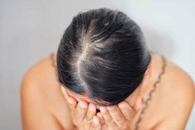 Rụng tóc sau COVID-19: Bạn có nên lo lắng? - Ảnh 4.