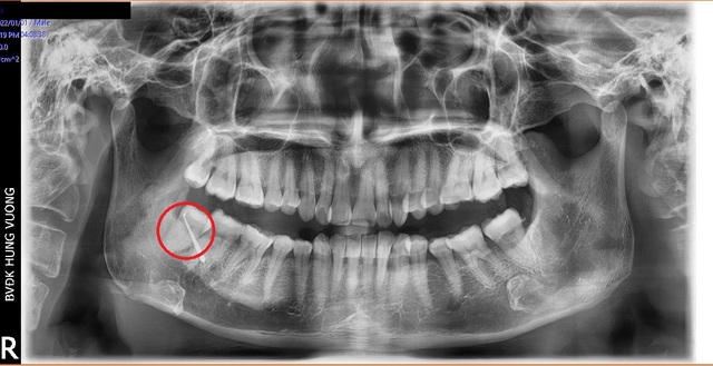 Hy hữu: Bệnh nhân bị... thủng má do biến chứng răng số 48 mọc lệch - Ảnh 1.