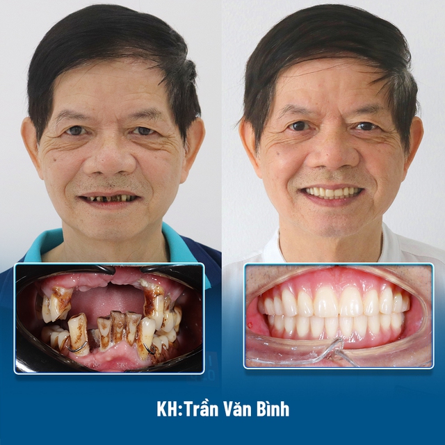 Sai lầm phổ biến khi trồng răng implant - Ảnh 3.