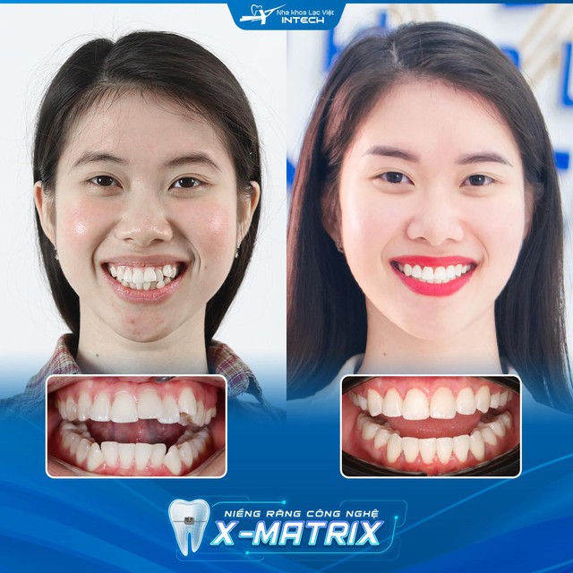 Việc biết trước kết quả niềng răng chính xác 99.9% mang lại những khác biệt gì? - Ảnh 3.