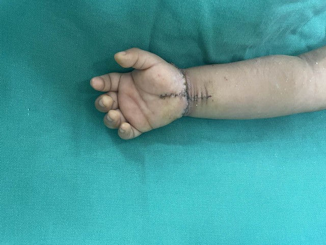 Nối bàn tay bị đứt lìa do tai nạn máy dập nắp cốc nhựa cho bé trai 21 tháng tuổi - Ảnh 1.