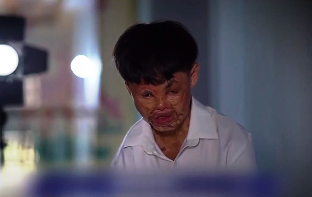 Kỳ tích tái tạo khuôn mặt cho bệnh nhân bị bỏng nặng từ nhỏ - Ảnh 2.