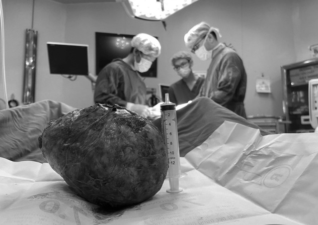 Cắt khối bướu giáp đeo bám 40 năm cho bệnh nhân 92 tuổi - Ảnh 1.