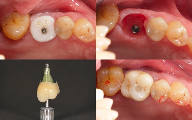Ánh đen răng, lợi không ôm sát chân răng khi trồng implant báo hiệu điều gì? - Ảnh 3.