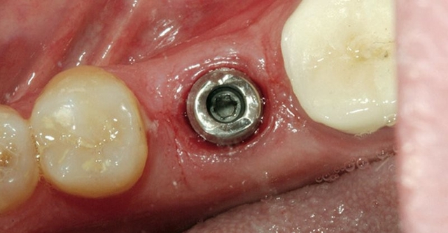 Ánh đen răng, lợi không ôm sát chân răng khi trồng implant báo hiệu điều gì? - Ảnh 2.