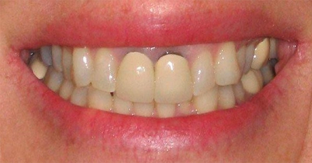 Ánh đen răng, lợi không ôm sát chân răng khi trồng implant báo hiệu điều gì? - Ảnh 1.