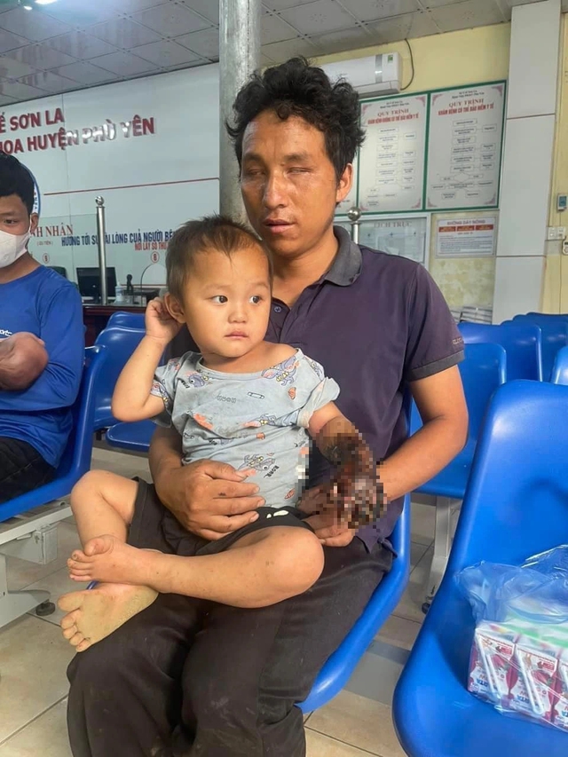 Cộng đồng cứu giúp cánh tay bị bỏng nặng cho cháu bé ở Sơn La với 160 triệu đồng - Ảnh 1.
