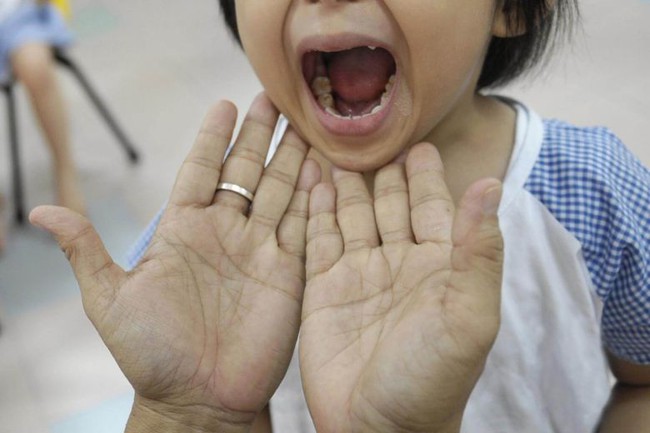 Hand, foot and mouth disease can damage the brain, lungs or heart, though such complications are rare. PHOTO: ST FILE