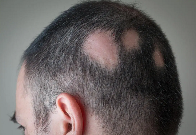 Rụng tóc nhiều ở nam giới là bệnh gì  6 cách xử lý tại nhà
