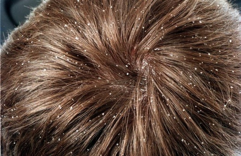 Rụng tóc, gàu và nấm da đầu - Bệnh gì? | VTV.VN