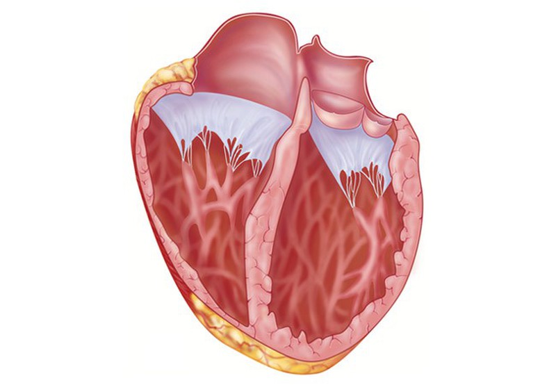 Желудочка сердца расширена. Кардиопатия дилатационная кардиомиопатия. Кардиомиопатия и миокардиодистрофия. Тонзиллогенная кардиомиопатия. Кардиомиопатия патанатомия.
