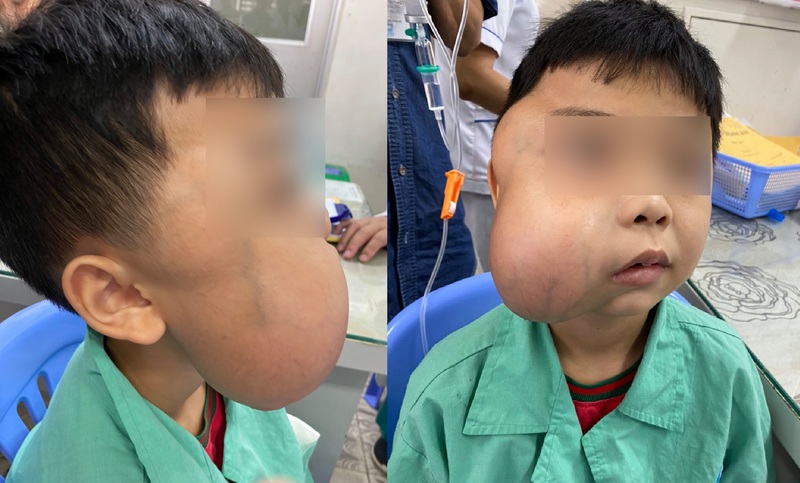 Cắt bỏ khối u xơ vòm mũi họng khổng lồ cho bé trai 13 tuổi | VTV.VN