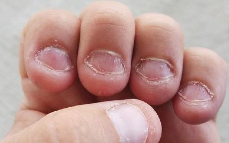 Cắn móng tay có thể gây tổn thương và nhiễm trùng cho đôi tay của bạn. Hãy cùng xem những hình ảnh liên quan để tìm hiểu cách chăm sóc móng tay và tránh cắn móng tay nhé.