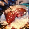 Successful liver transplant for the smallest patient in Vietnam