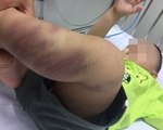 Hà Nội: Điều tra vụ bé trai 1 tuổi nghi bị bạo hành nghiêm trọng