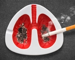 96,8 các ca ung thư phổi có liên quan đến thuốc lá