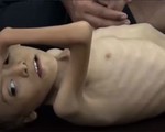 Thế hệ trẻ em suy dinh dưỡng sau chiến tranh tại Yemen