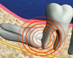 Răng khôn - khôn hay dại?