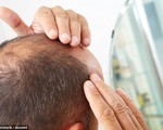 Nguy cơ bệnh tim mạch tăng cao ở những người hói đầu và có tóc bạc sớm