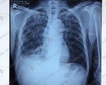 Bùng phát lao phổi trên bệnh nhân suy nhược cơ thể