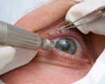 Sau phẫu thuật đục thủy tinh thể, mắt cần chăm sóc thế nào?
