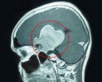 Hơn 5 giờ mổ khối u não khổng lồ cho nữ bệnh nhân