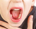Hạch cổ dưới hàm có thể là dấu hiệu cảnh báo ung thư vòm họng
