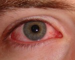 Nhìn vào người đau mắt đỏ có bị lây?