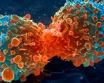 Phương pháp mới ngăn chặn tế bào ung thư phát triển