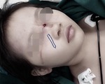 Bé gái 6 tuổi bị bút chì đâm xuyên sống mũi do té ngã